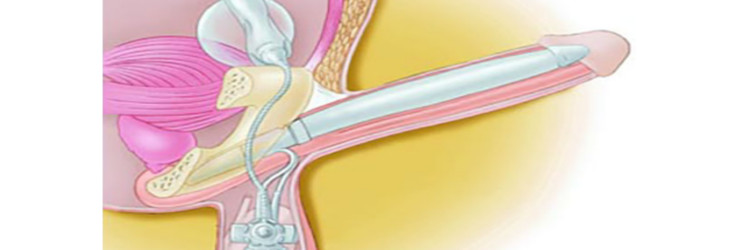 kidney stone disease 1